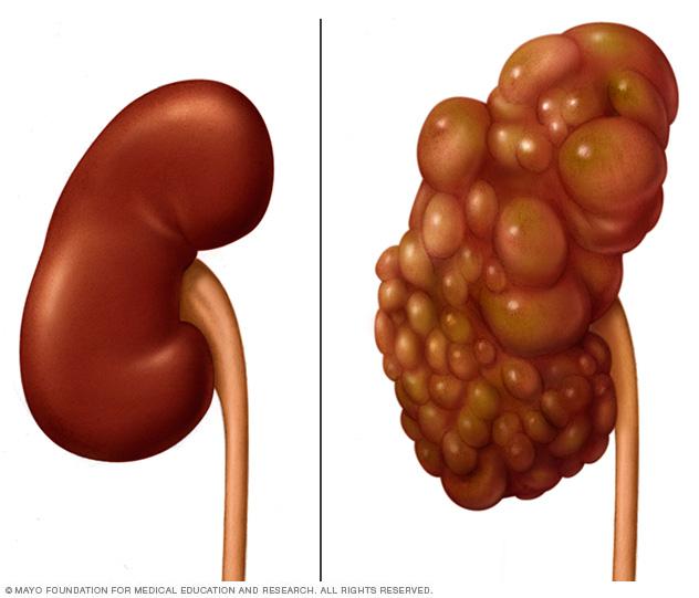 A typical kidney compared with a polycystic kidney